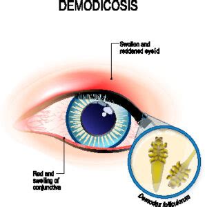 treat red irritated burning eyelids blepharitis demodex mites