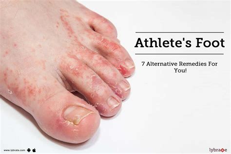 athletes foot  alternative remedies    dr neeraj gupta