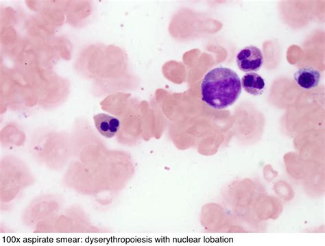 pathology outlines mds mpn with ring sideroblasts and thrombocytosis