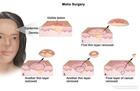 mohs surgery knight cancer institute ohsu