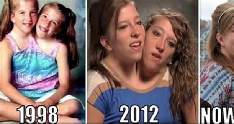 interesting things about famous conjoined twins abby and