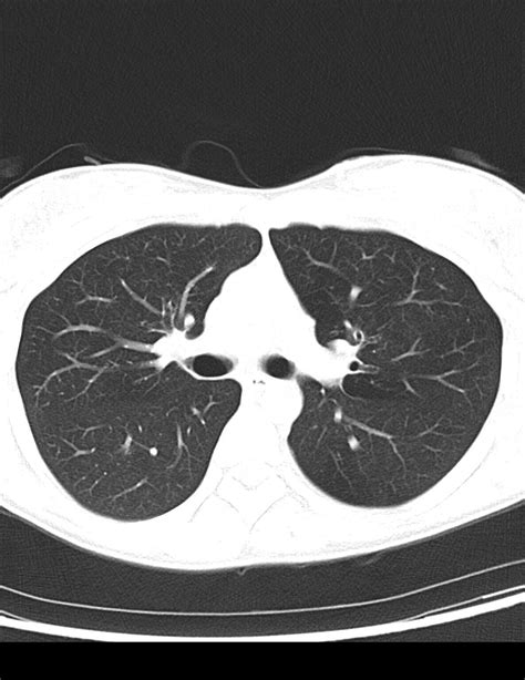 Lung Cancer Screening Low Dose Ct Uf Health Jacksonville