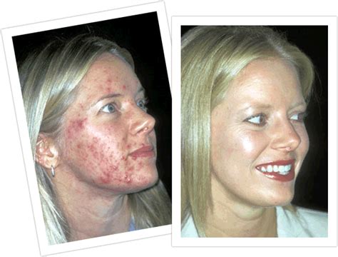 facial acne scarring laser surgery excelent porn