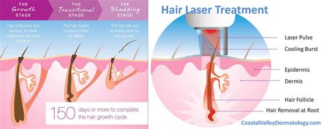 laser hair removal coastal valley dermatology