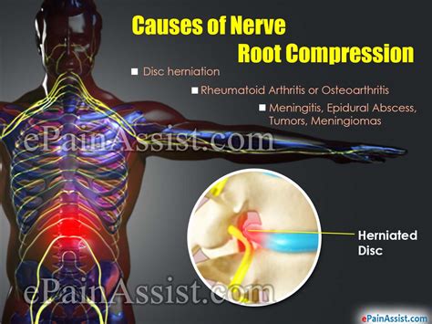 nerve root compression treatment  symptoms
