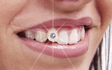 diamonds  teeth ahmedabad tooth jwellery tooth crystals laminates