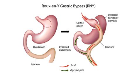 What Is The Difference Between Lap Band Surgery And Gastric Bypass