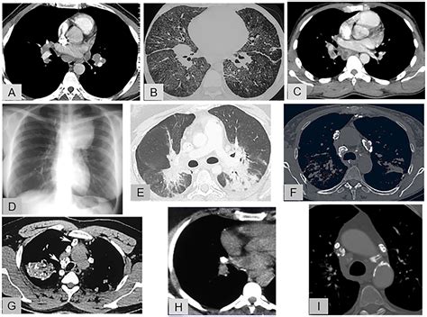 Frontiers Differential Diagnosis Of Pulmonary Sarcoidosis A Review