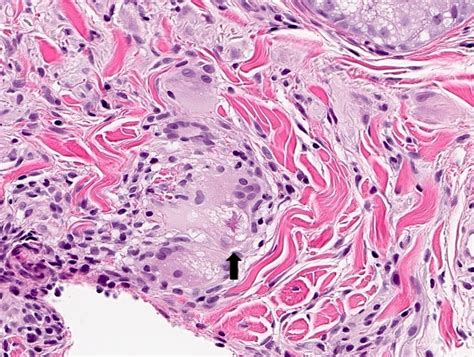 Pathology Outlines Sarcoidosis