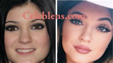 Kylie Jenner Plastic Surgery Before And After Photos
