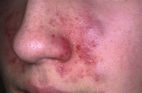 seborrheic dermatitis pictures  symptoms treatment  cure