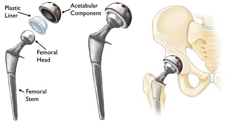 minimally invasive total hip replacement orthoinfo aaos