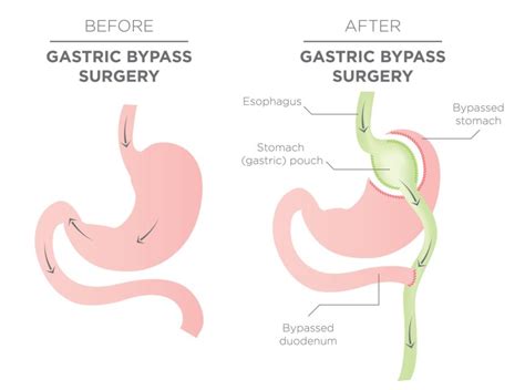 Roux En Y Gastric Bypass Surgery And Its Effectiveness