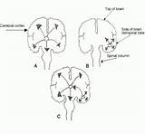Seizures Epilepsy Partial Generalization Seizure Classification Generalized sketch template