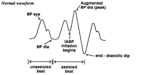 interpretation  arterial waveform  iabp assistance member login