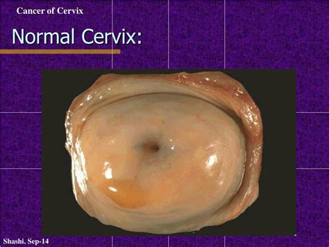 Ppt Pathology Of Cervical Carcinoma Powerpoint Presentation Free