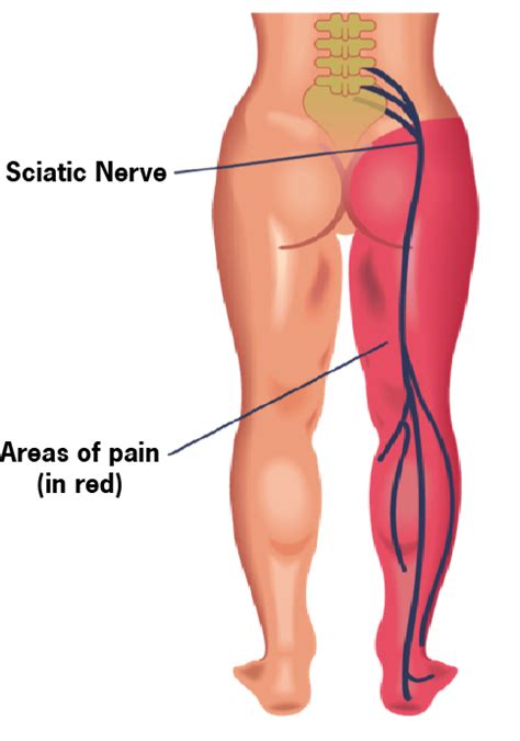 How To Treat Sciatica Or Sciatic Nerve Pain