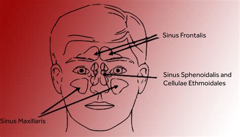 sinus headache    atyutka health