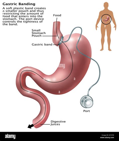illustration  gastric banding  laparoscopic adjustable gastric band commonly called  lap