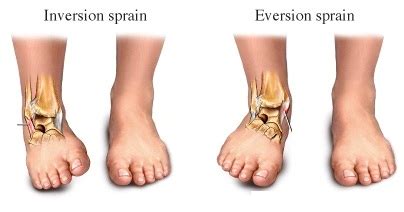 inversion ankle sprains chiropractor vancouver