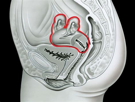 Hysterectomy Photograph By John Bavosi Science Photo Library Fine Art