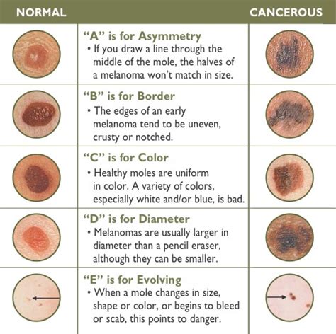 What Do Skin Cancers Types Look Like « Cancerworld