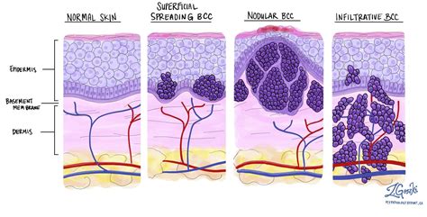basal cell carcinoma   skin mypathologyreportca