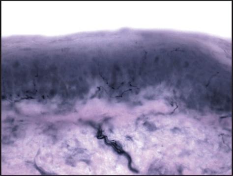 epidermal nerve fiber density testing an overview bako diagnostics
