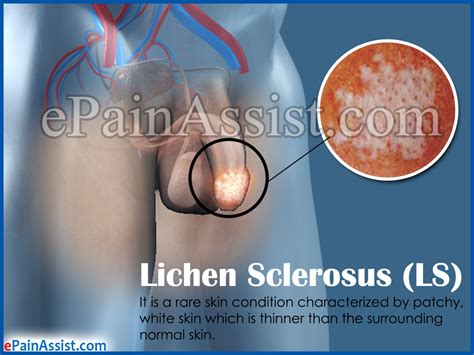 lichen sclerosus ls causes signs symptoms