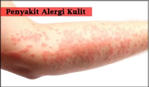ciri penderita gatal gatal  alergi  obat