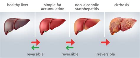 non alcoholic fatty liver disease genes and diet