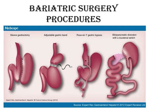 bariatric surgery  psychiatric perspective powerpoint