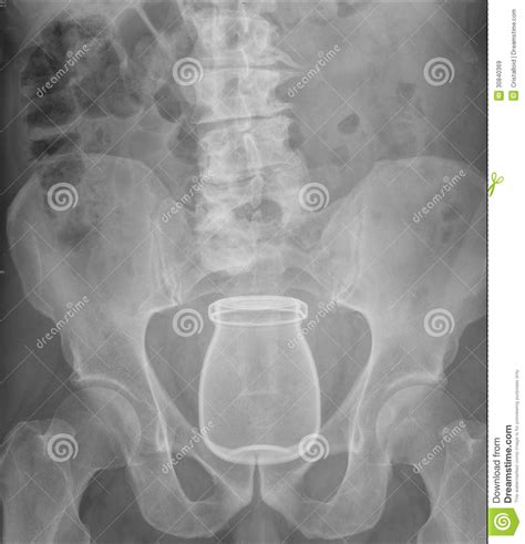X Ray Of Pelvis With Glass Inserted In Rectum Royalty Free