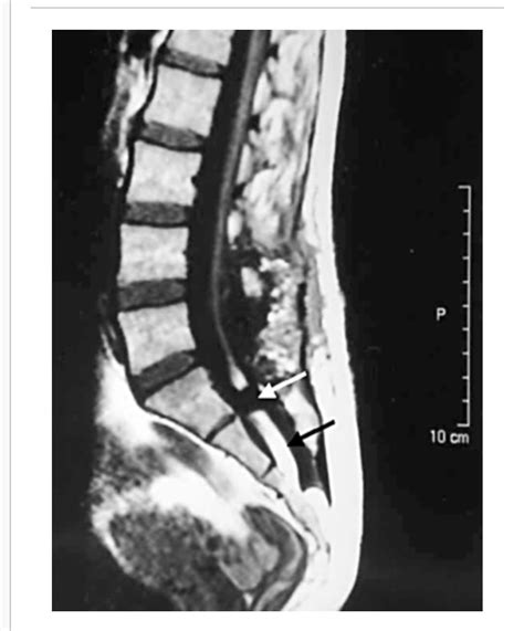 pin  persistent pain disability