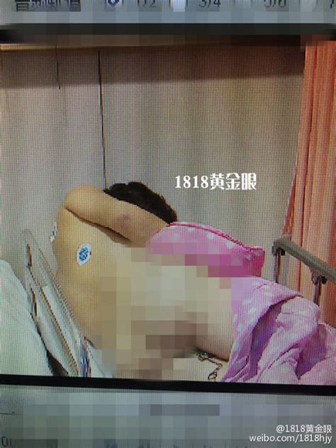 chinese man gets knife stuck in his butt while trying to rid himself of hemorrhoids news am
