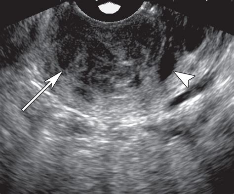 us of the nongravid cervix with multimodality imaging correlation