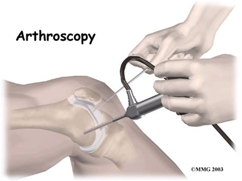 diagnostic arthroscopy