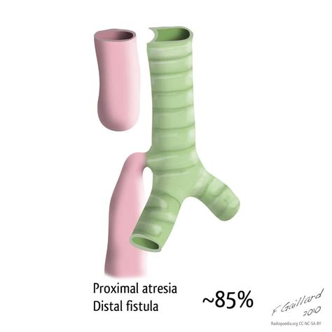 Tracheo Oesophageal Fistula Types Diagrams Radiology Case