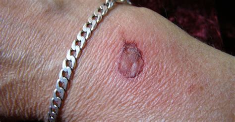 skin grafts healing livestrongcom