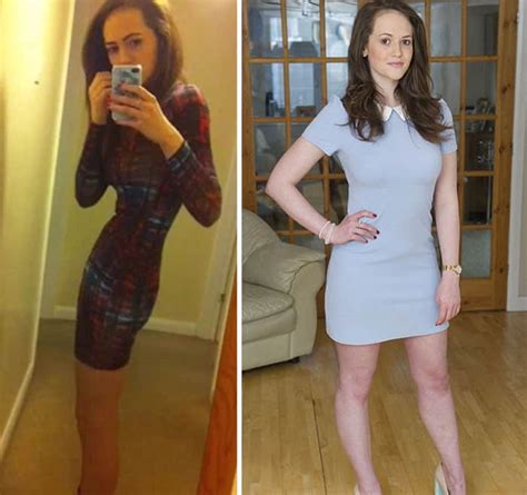 45 ‘before And After’ Photos Of People Who Beat Anorexia True Activist