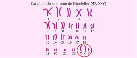 O Que é Síndrome De Klinefelter Sololearn