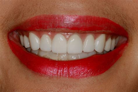 veneers  create larger teeth konig center  cosmetic