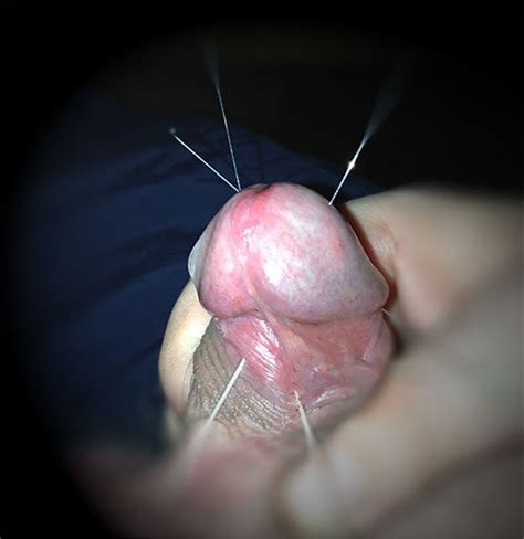 needles in cock photo album by jedi64 xvideos