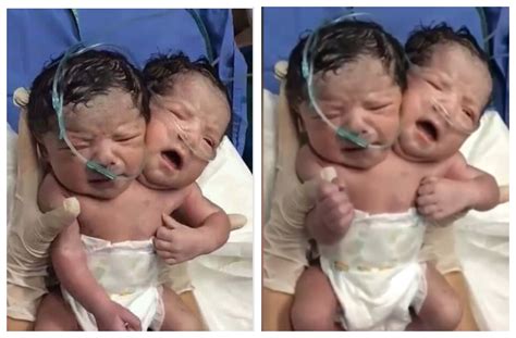 2017 photo of conjoined twins from mexico viral as recent in