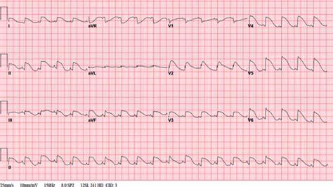 An Infant With Hemodynamic Collapse Circulation