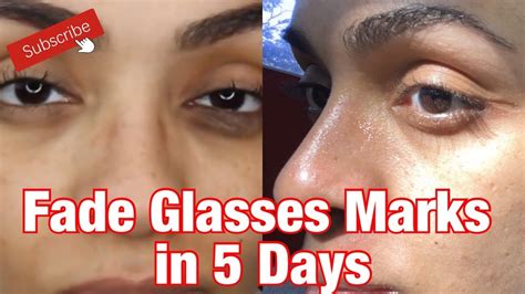 removed  glasses marks    days diy spot treatment