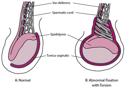 figure abnormal testicular fixation leading  torsion msd manual professional edition