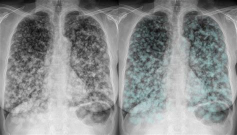 chest  ray lung cancer metastases  lung