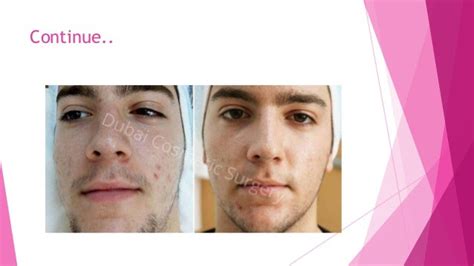 acne treatments   results