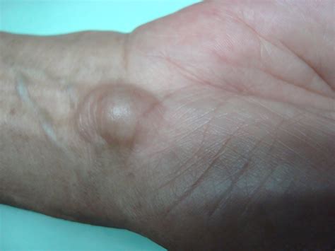 treated   year  female  ganglion cyst   wrist